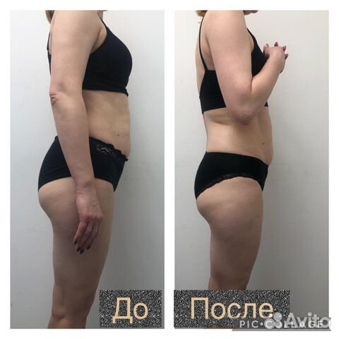 Массаж Антицеллюлитный Похудение Лучше LPG