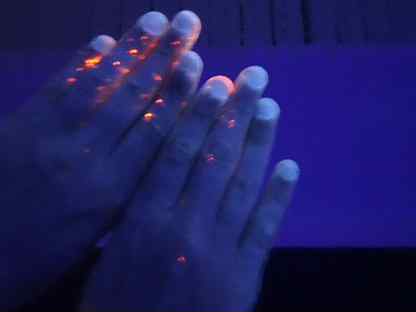 Грибок ногтей под лампой вуда фото